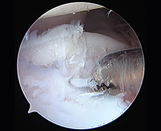 scope camera showing elbow dysplasia in pet Spry Companions Veterinary Orthopedic Specialists Centennial, Colorado