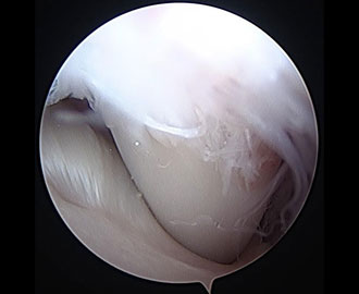 scope camera view of shoulder disorder in animal Spry Companions Veterinary Orthopedic Specialists Centennial, Colorado