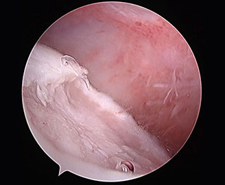 scope view of OCD Osteochondrosis Osteochondritis-Dissecans disease Spry Companions Veterinary Orthopedic Specialists Centennial, Colorado